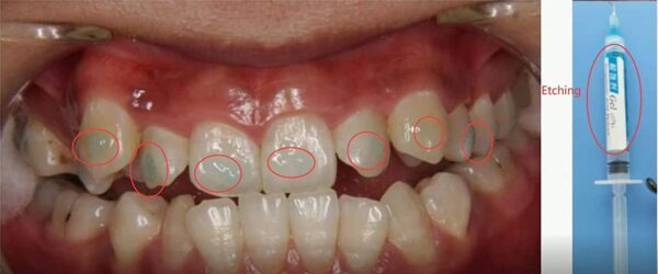 1 Kit OrthoForce® Bricolaje Adhesivo Ortodoncia Dental Cemento Dental Metal Brace - Image 4