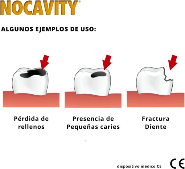 Nocavity - Kit de relleno dental temporal - Aísla la cavidad dental y reduce el dolor en caso de pérdida de empastes, pequeñas caries y dientes rotos - Image 4