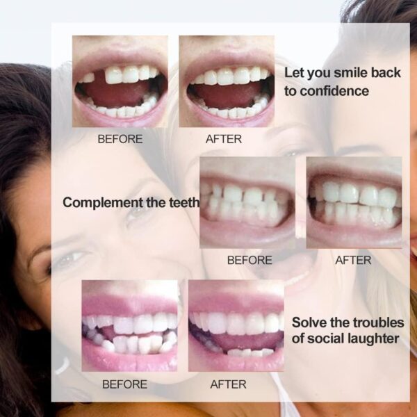 Kit de Reparación de Dientes Temporal, Reemplazos de Dientes Temporales, Dientes falsos moldeables temporales para reparar el relleno del diente roto faltante, Ajuste Instantáneo y Sonrisa Segura,10ml - Image 2