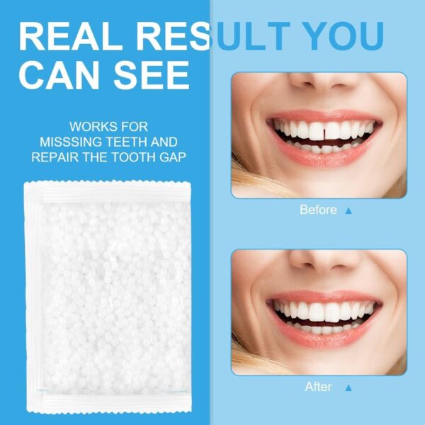 ACWOO Perla Dental, Dientes falsos moldeables temporales, Reemplazos de Dientes Temporales, 50g Perlas de Reparación de Dientes Temporales para Dientes Rotos Faltantes, Material de Relleno de Dientes - Image 5