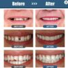 Gegong Clip en los dientes de las carillas, perlas de reparación de dientes temporales para faltar dientes rotos material de llenado dental dental, cemento de dientes (100g) - Image 3