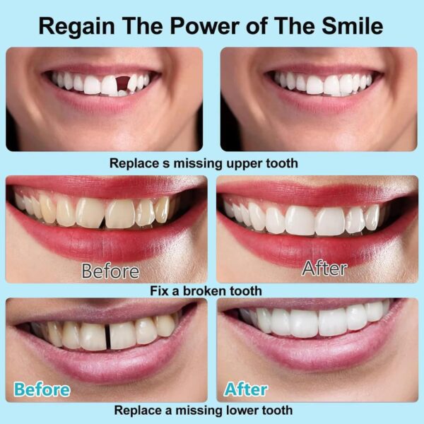 Dientes de Carillas Cosméticas, Dentaduras Postizas Instantáneas, Dentaduras Temporales, Postizos de Superior E Inferior Dientes, Sonrisa Dientes Prótesis Chapa,Mandíbula Superior y Mandíbula Inferior - Image 3