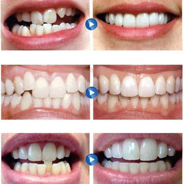 2 Pares Dentaduras Postizas Instantáneas, Dientes de Carillas Cosméticos Carillas Dentales Carillas Falsa Temporales de Dientes para Mujeres Hombres - Image 2
