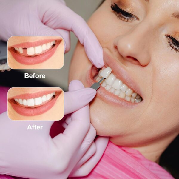 SKHAOVS 7 Pares Dentaduras Postizas Instantáneas, Dientes de Carillas Cosméticas, Dentaduras Temporales Postizos de Superior E Inferior Dientes, Perfecta Sonrisa Dientes Prótesis Chapa - Image 4