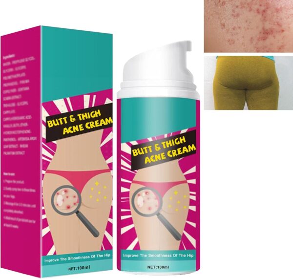 Crema de Acné de Cadera,Crema para Eliminar el Acné en los Glúteos,Crema para el Acné,Butt Acne Clearing Spot Tratamiento Crema,Tratamiento de Glúteos,Tratamiento de Gluteos Acné,Acne Espalda