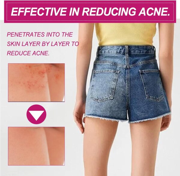 Crema de Acné de Cadera,Crema para Eliminar el Acné en los Glúteos,Crema para el Acné,Butt Acne Clearing Spot Tratamiento Crema,Tratamiento de Glúteos,Tratamiento de Gluteos Acné,Acne Espalda - Image 3