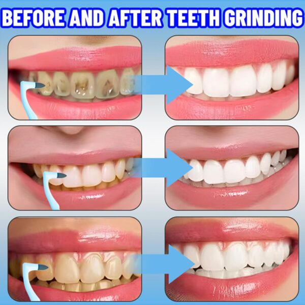 YIUWOD 8 Piezas，Limpiador Sarro Dental - Quita Sarro Dental - Quitar Sarro Dientes - Adecuado Para La Limpieza Dental Profesional, Puede Eliminar Manchas de Té, Manchas de Café Y Manchas de Jugo - Image 3