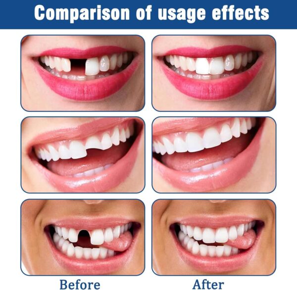 Resina Para Dientes ReparacióN De Dientes Perlas De ReparacióN De Dientes Resina Dental Dientes Postizos Temporales Resina Para Dientes ReparacióN De Dientes Resina Dental Con Herramientas Orales - Image 2